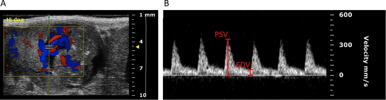 Color Doppler Bild und Pulse-wave-Doppler Bild